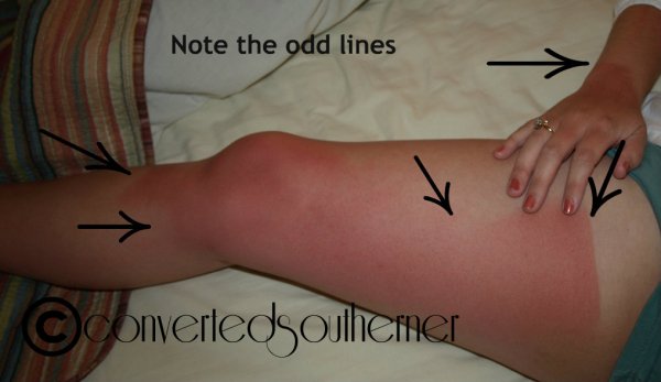 The worst sunburn ever