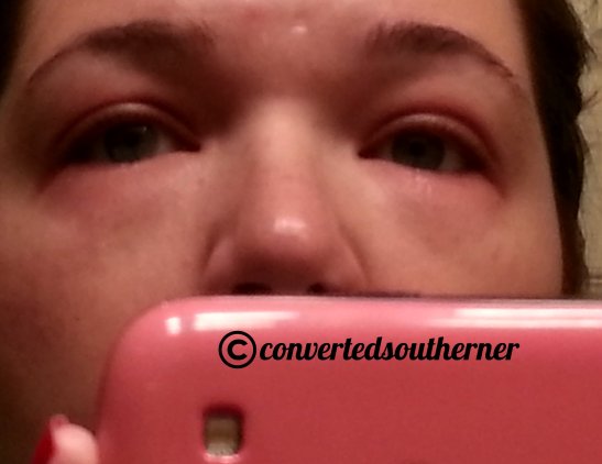 allergic reaction to mascara